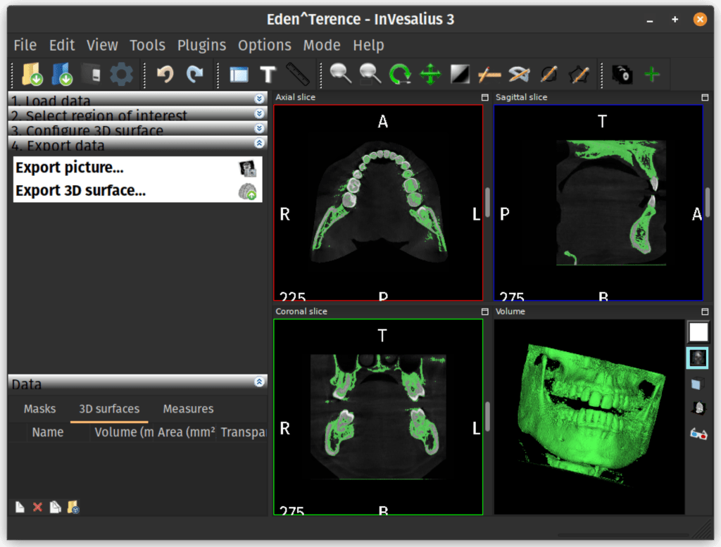 InVesalius showing the export screen.